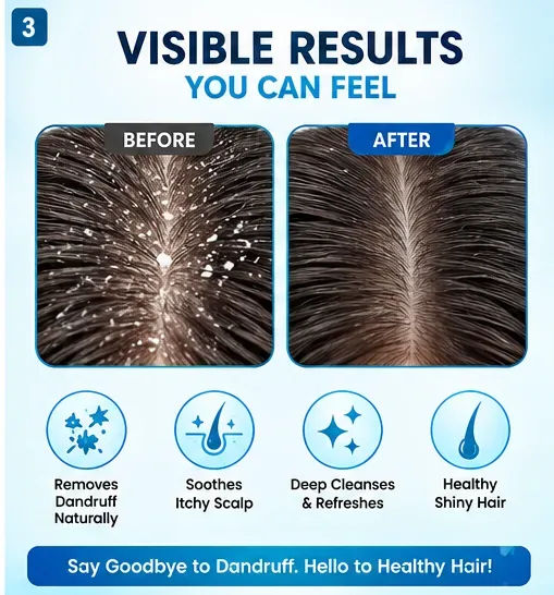 Anti Dandruff Shampoo 250ml thumbnail 4